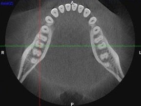 3 D CBCT Scan